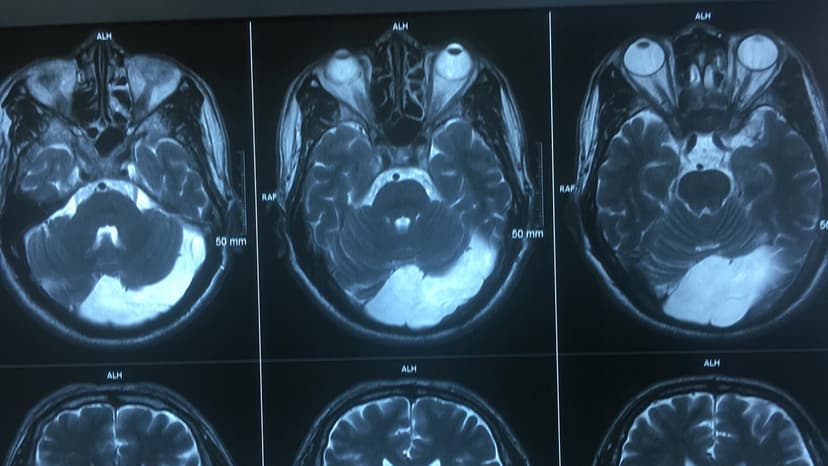 4 Phương pháp chẩn đoán hình ảnh u màng não phổ biến