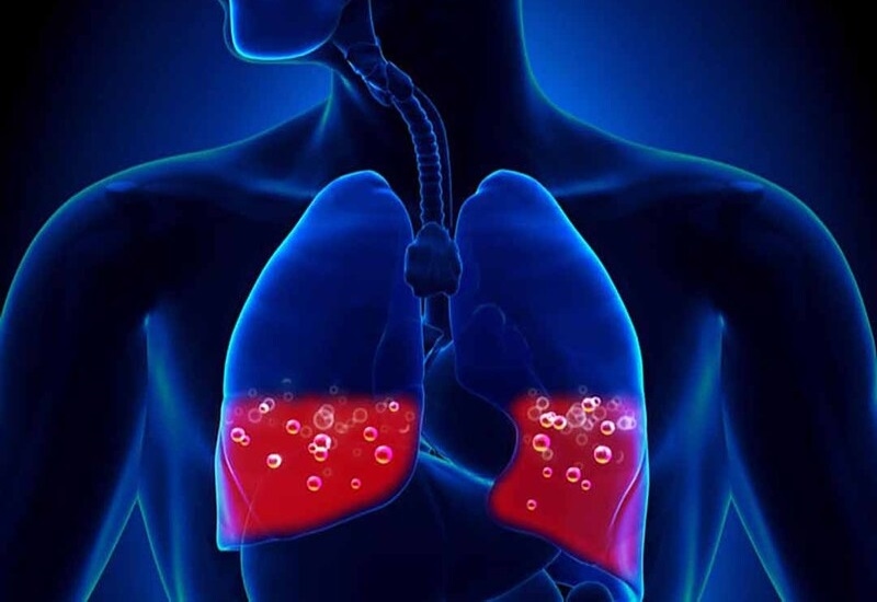 chỉ định chẩn đoán hình ảnh phù phổi cấp