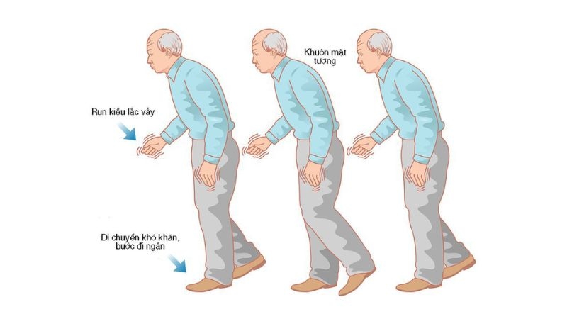 Chẩn đoán bệnh Parkinson thông qua các triệu chứng lâm sàng