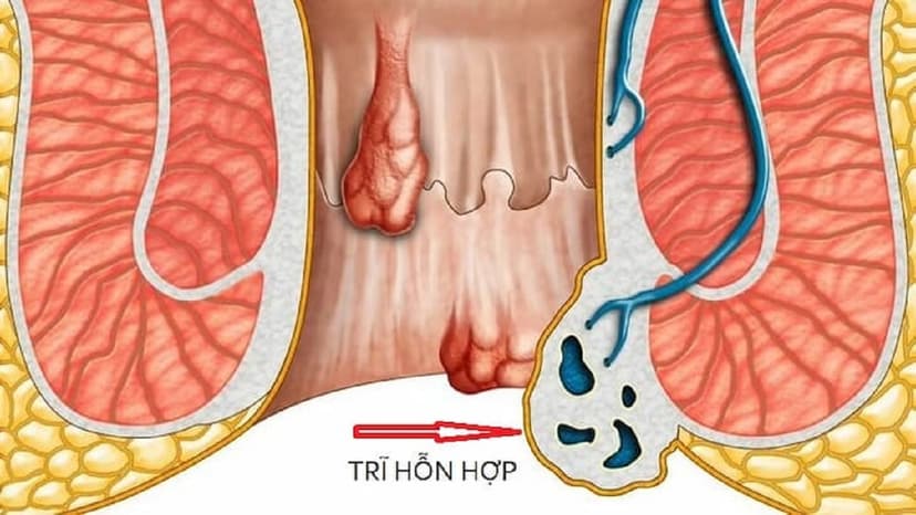 Bệnh trĩ hỗn hợp: Nguyên nhân, triệu chứng và điều trị hiệu quả