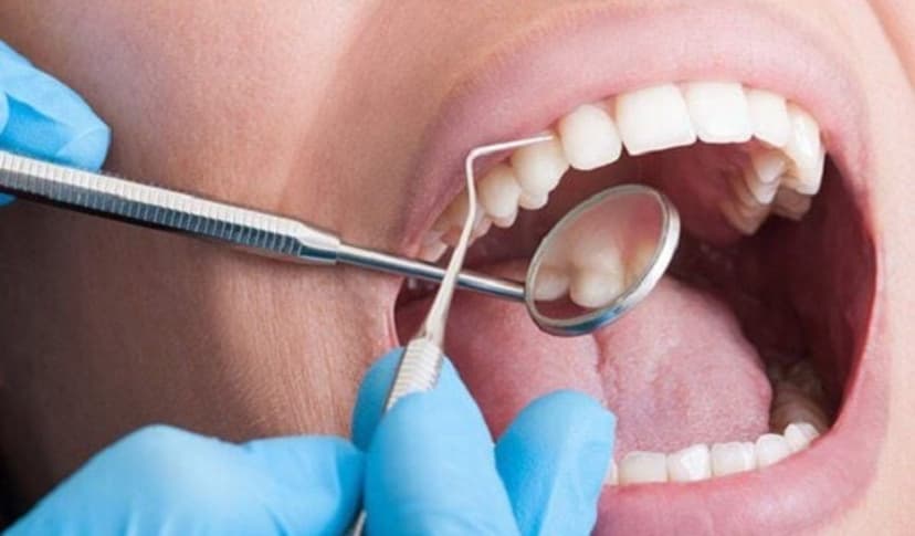 Tần suất lấy cao răng hợp lý để bảo vệ nướu và răng