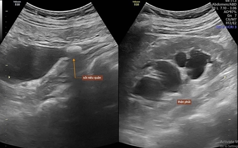 chẩn đoán hình ảnh thận - tiết niệu