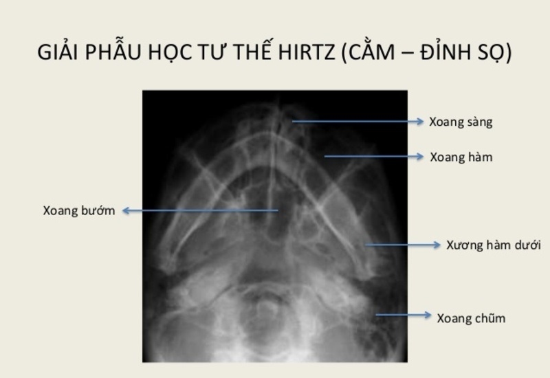 Chụp X-quang viêm xoang tư thế Hirtz