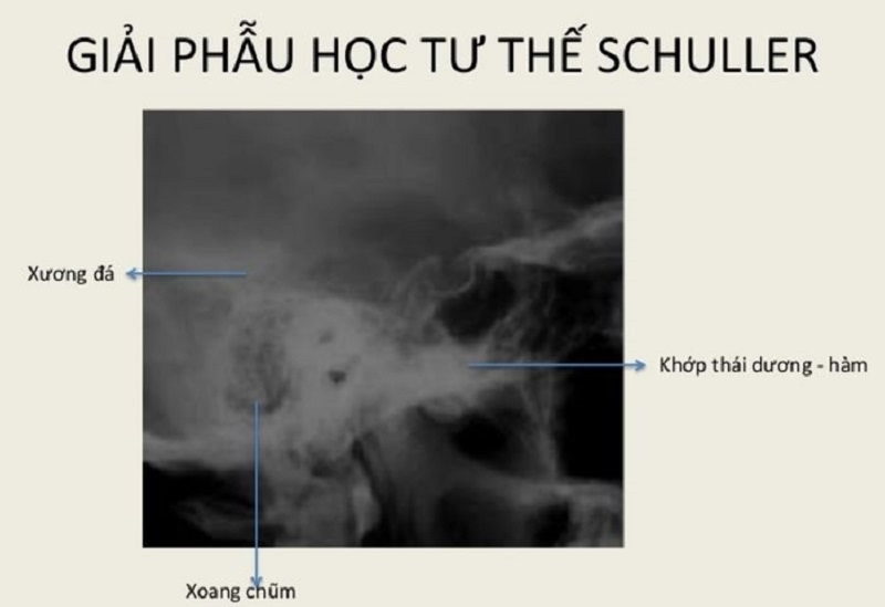 Chẩn đoán hình ảnh viêm xoang bằng chụp X-quang tư thế Schuller