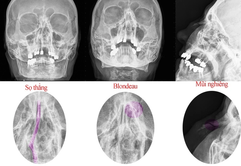 Quy trình chụp X quang chẩn đoán bệnh viêm xoang