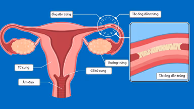 Chỉ định và chống chỉ định thực hiện chụp X quang vòi trứng