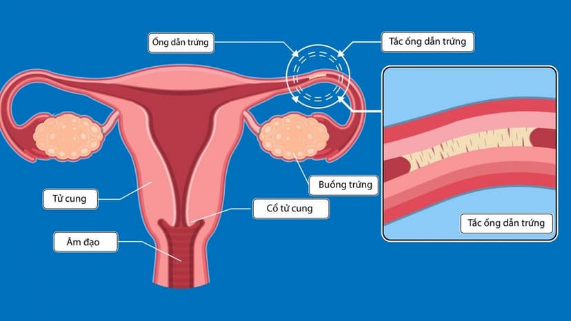 Chỉ định và chống chỉ định thực hiện chụp X quang vòi trứng