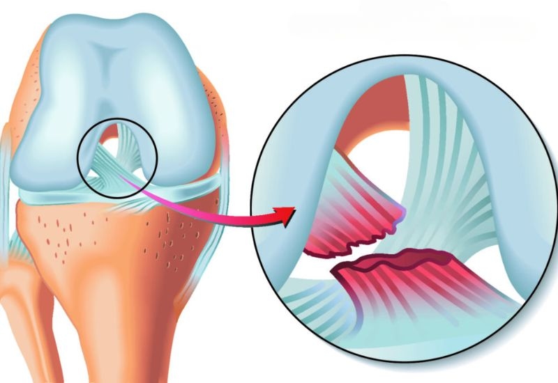 Cách phòng tránh thoái hóa khớp sớm sau chấn thương dây chằng chéo khớp gối