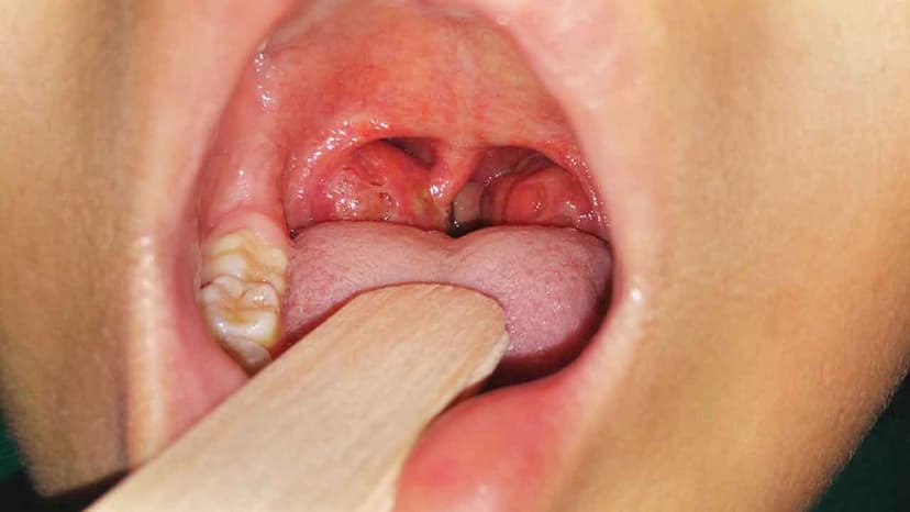 Điều trị viêm amidan cấp an toàn, hiệu quả