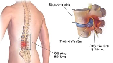 Giá tiền chụp MRI cột sống thắt lưng và yếu tố ảnh hưởng