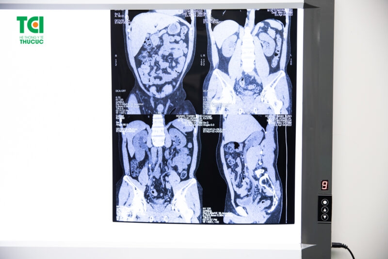 Cơ chế hình thành giãn đài bể thận và niệu quản do sỏi tiết niệu