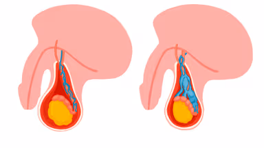 Giãn tĩnh mạch thừng tinh: Bệnh lý nam khoa và điều cần biết