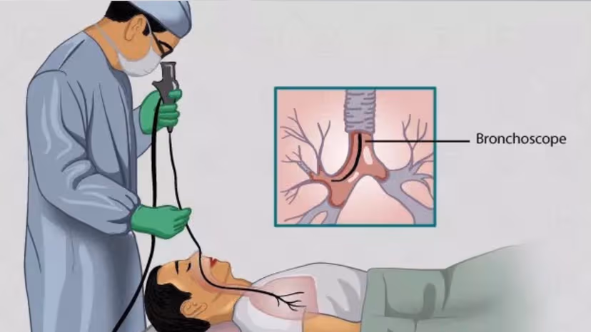 Vai trò và quy trình thực hiện kỹ thuật nội soi phế quản