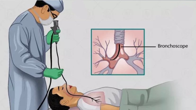 Vai trò và quy trình thực hiện kỹ thuật nội soi phế quản
