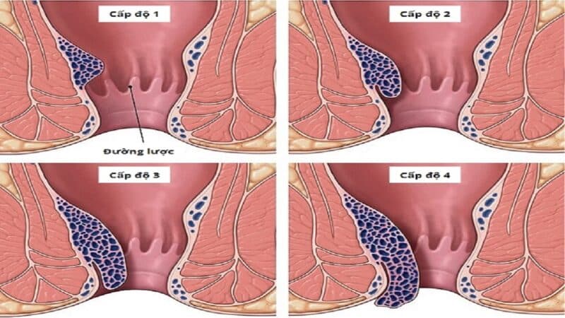 Bệnh trĩ nội thường trải qua 4 cấp độ chính - quá trình phát triển của bệnh trĩ