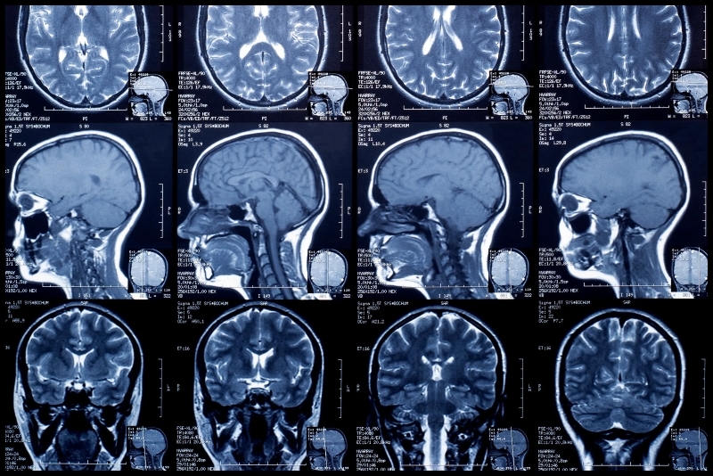 hình ảnh chụp MRI phát hiện bệnh về não
