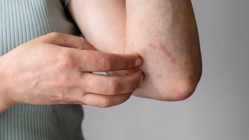 Hướng dẫn xử lý tình trạng tiêm vắc-xin về bị ngứa