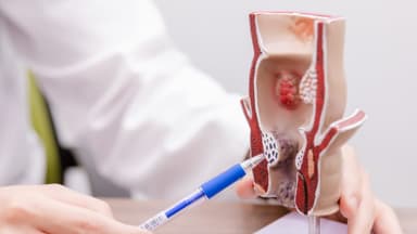 Trĩ nội có gây đau bụng không và cách xử lý