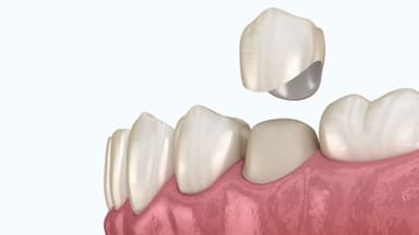 Úp răng sứ và những lợi ích vượt trội trong nha khoa thẩm mỹ
