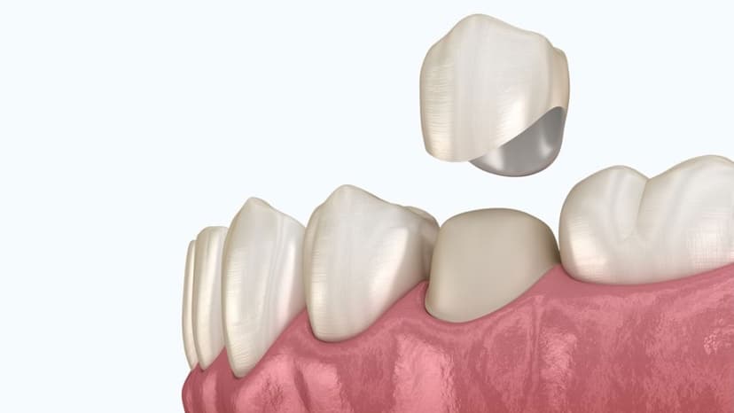 Úp răng sứ và những lợi ích vượt trội trong nha khoa thẩm mỹ