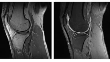 Ưu điểm và ứng dụng của hình ảnh MRI khớp gối trong khám bệnh