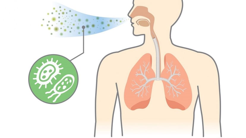 4 Phương pháp điều trị viêm phổi bạn cần biết