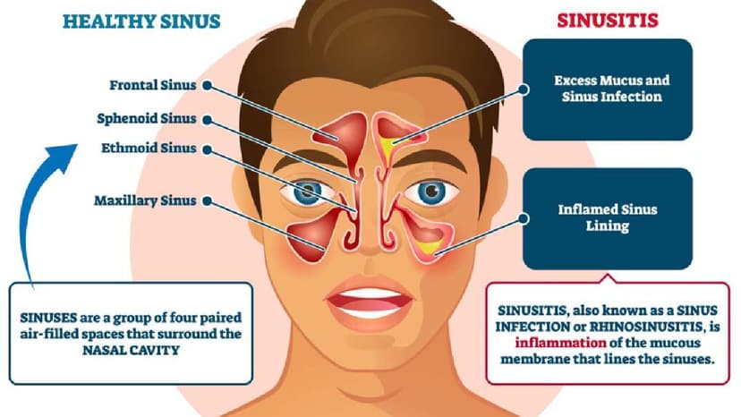 Bệnh viêm xoang mũi và cách xử lý