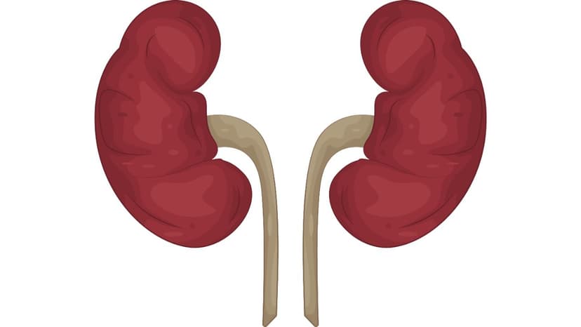 5 Biến chứng nếu không điều trị sỏi đường tiết niệu kịp thời