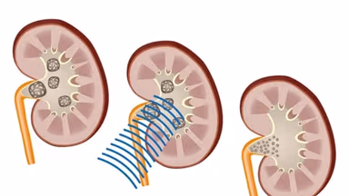 Cách điều trị sỏi tiết niệu bằng công nghệ tán sỏi hiện đại