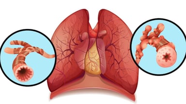 Giải đáp câu hỏi giãn phế quản là gì và phương pháp điều trị