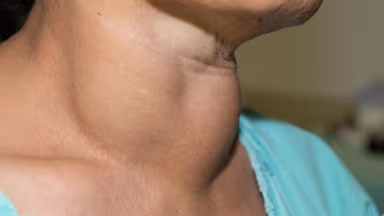 Phân biệt cường giáp và bướu cổ, cách kiểm soát