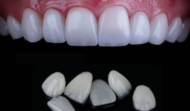 8 Lợi ích vượt trội của dán sứ veneer trong việc phục hồi hàm răng