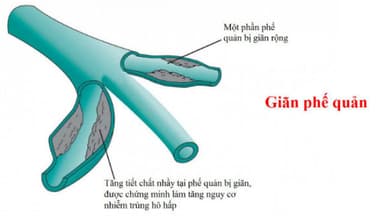 Nguyên nhân phổ biến dẫn đến bệnh giãn phế quản