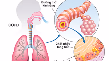 Nguyên nhân phổ biến dẫn đến viêm phế quản mãn tính
