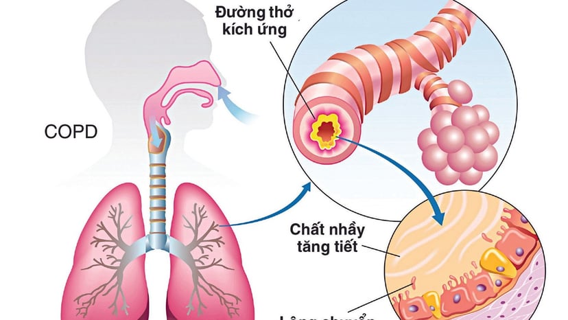 Nguyên nhân phổ biến dẫn đến viêm phế quản mãn tính