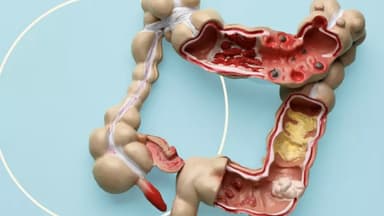 Nhận biết sớm các dấu hiệu cảnh báo ung thư đại tràng