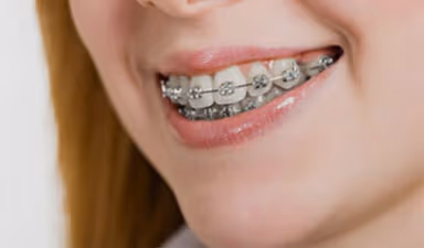 Niềng răng hô là gì? Quy trình, chi phí và những lưu ý quan trọng