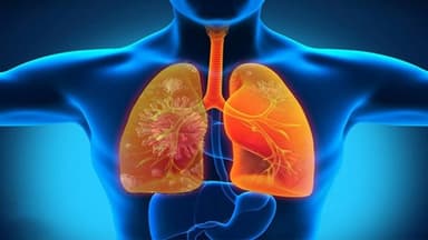 Phát hiện sớm bệnh lý thông qua các triệu chứng viêm phổi