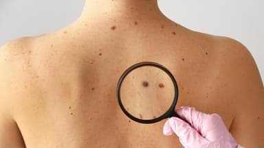 Phát hiện sớm các dấu hiệu của ung thư da