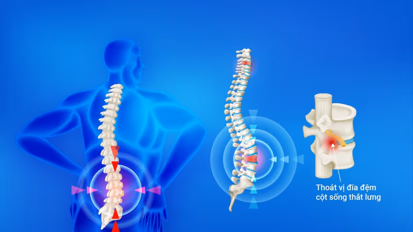 Thoát vị đĩa đệm cột sống thắt lưng: Những sai lầm trong điều trị
