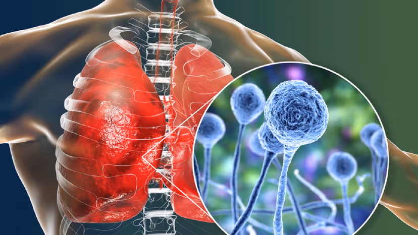 Tìm hiểu về 4 cách phân loại bệnh viêm phổi theo nguyên nhân