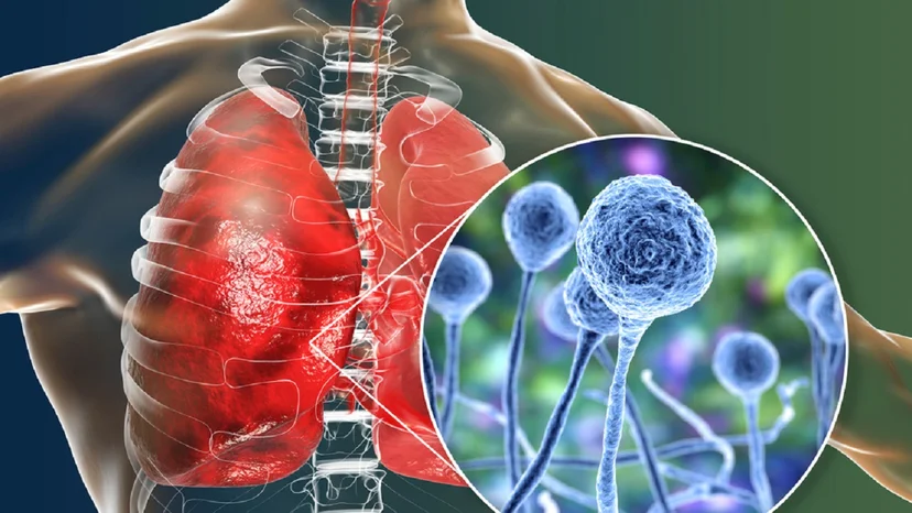 Tìm hiểu về 4 cách phân loại bệnh viêm phổi theo nguyên nhân