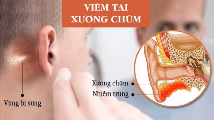 Viêm tai xương chũm – Bệnh lý cần cẩn trọng