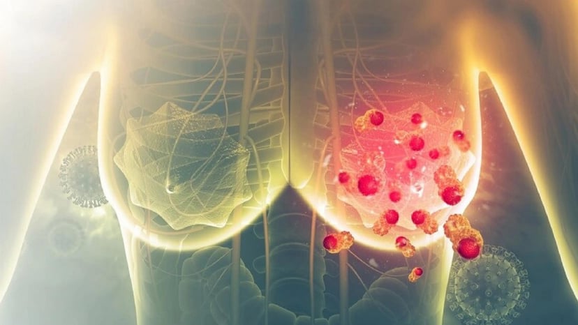 Yếu tố liên quan dẫn đến khởi phát căn bệnh ung thư vú