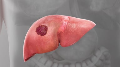 10 Dấu hiệu u gan mà bạn không nên chủ quan