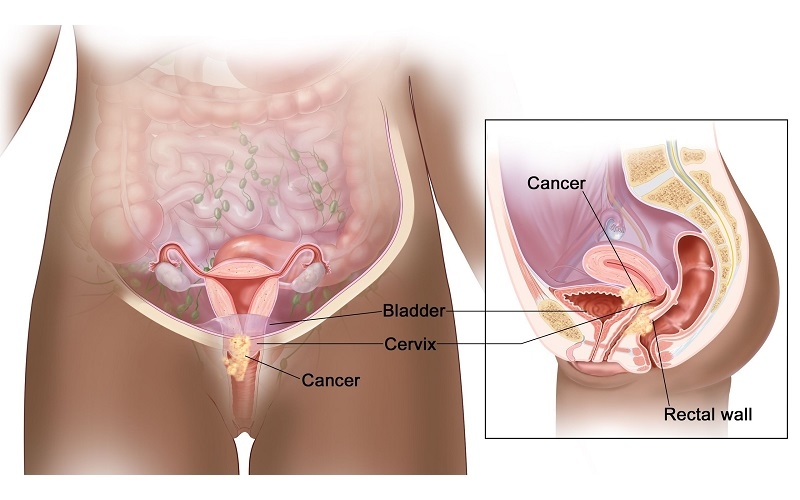 Ung thư cổ tử cung là tình trạng xuất hiện khối u ác tính tại cổ tử cung do sự tăng sinh bất thường của các tế bào biểu mô vảy hoặc biểu mô tuyến