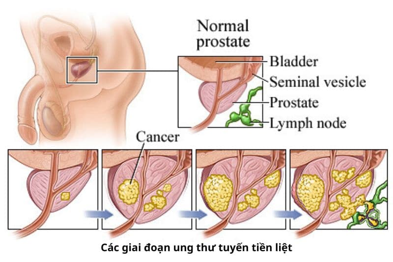 triệu chứng ung thư tuyến tiền liệt giai đoạn đầu không rõ ràng