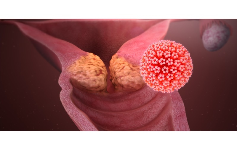 Ung thư cổ tử cung là bệnh lý ác tính hình thành khi các tế bào ở cổ tử cung (phần nối giữa tử cung và âm đạo) phát triển bất thường và không kiểm soát, tạo thành các khối u ác tính