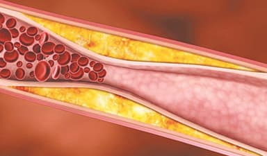 Những sai lầm phổ biến trong chế độ ăn của người bị mỡ máu