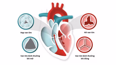 Bệnh hở van tim: Các dạng chính, đặc điểm và cách điều trị